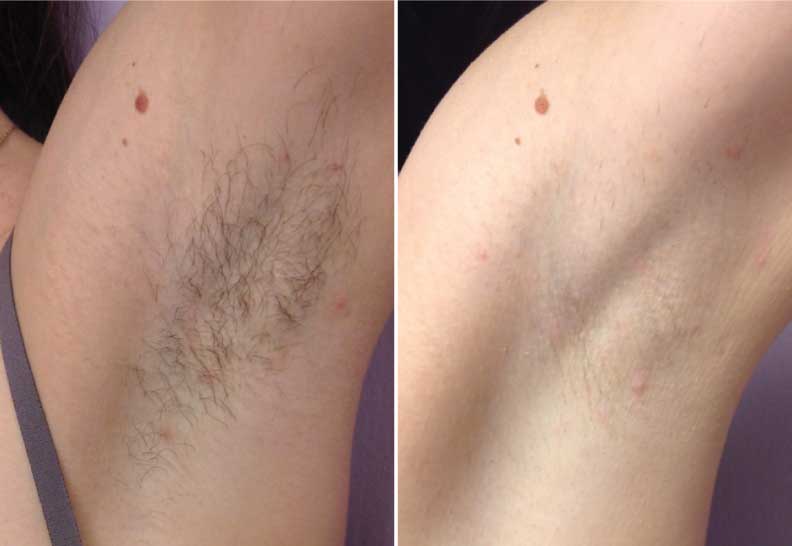 Laser Hair Removal - Before/After - Radiant Med Spas